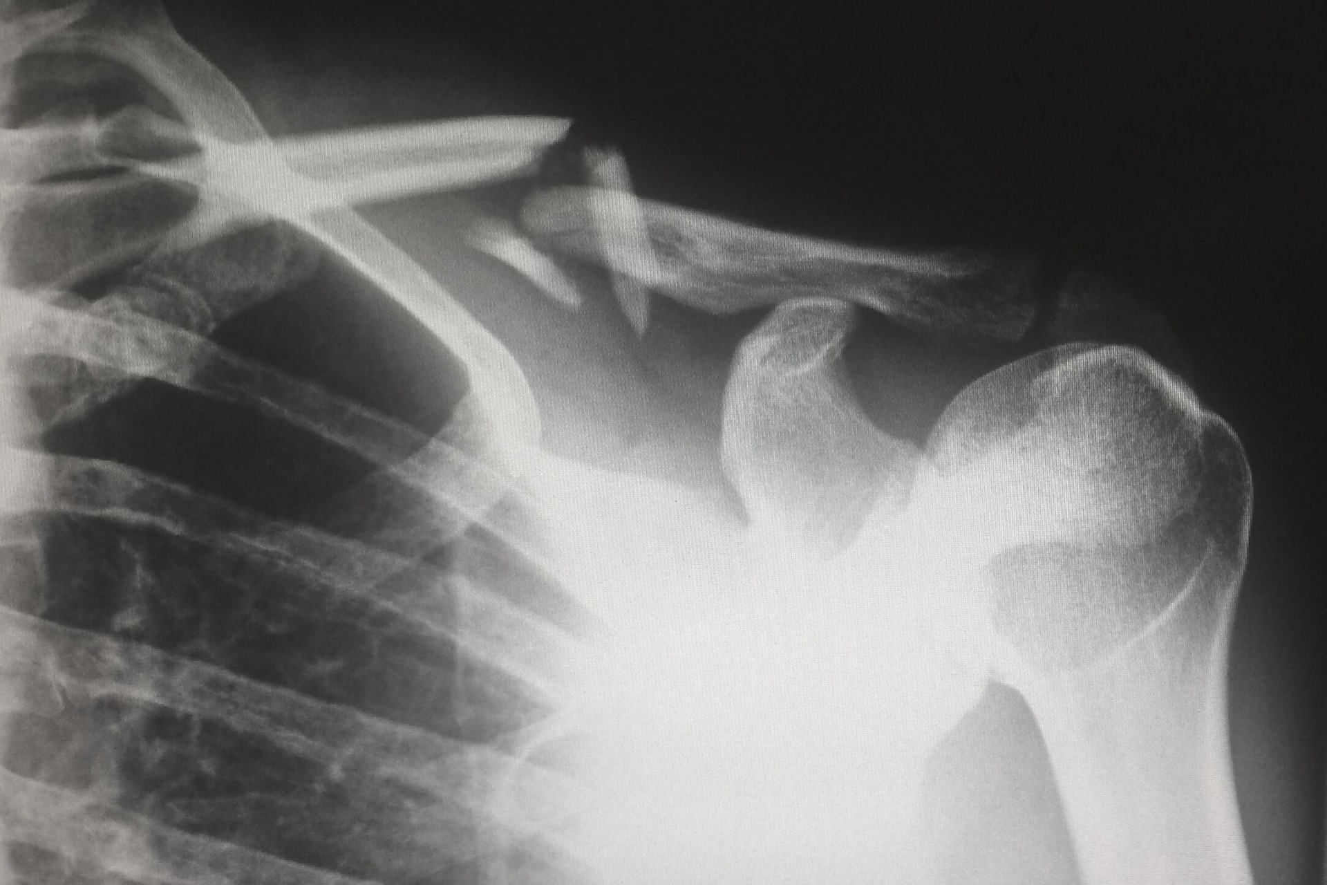 an x-ray of a shoulder
